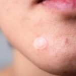 how do pimple patches work