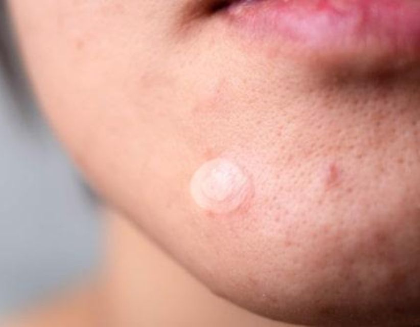 how do pimple patches work