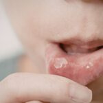 What Kills Cold Sores Instantly