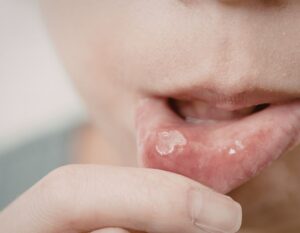 What Kills Cold Sores Instantly
