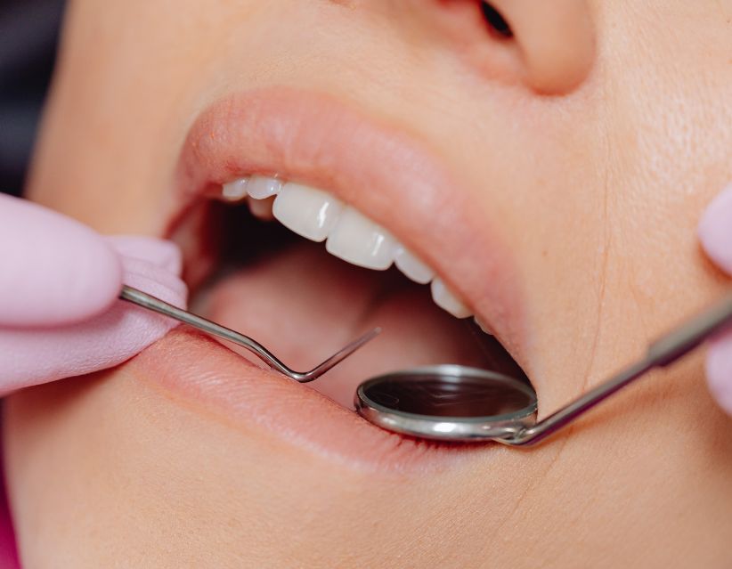 Black Triangle Teeth